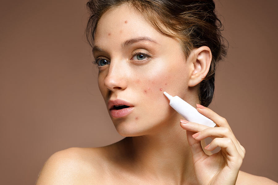 - Acne Gel