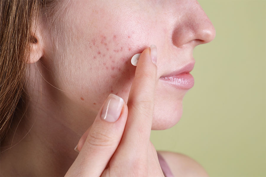 *Acne Care